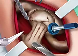 Ella Hip Surgery